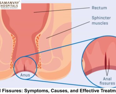Anal Fissures