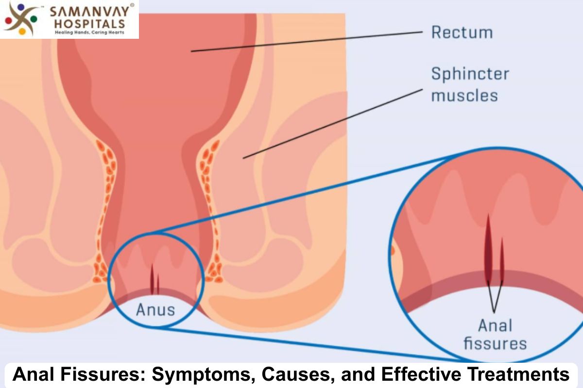 Anal Fissures: Symptoms, Causes, and Effective Treatments