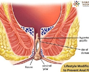 Prevent anal fissures