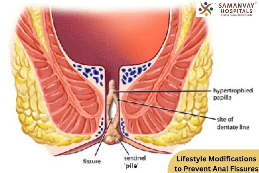 Lifestyle Modifications to Prevent Anal Fissures