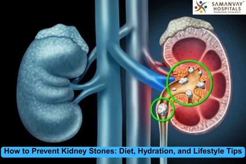How to Prevent Kidney Stones: Diet, Hydration, and Lifestyle Tips