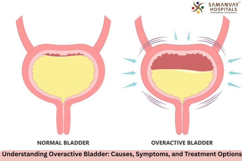 Understanding Overactive Bladder: Causes, Symptoms, and Treatment Options