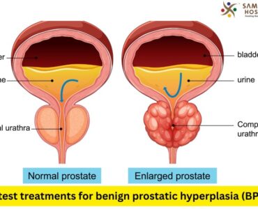 Latest treatments for benign prostatic hyperplasia (BPH)