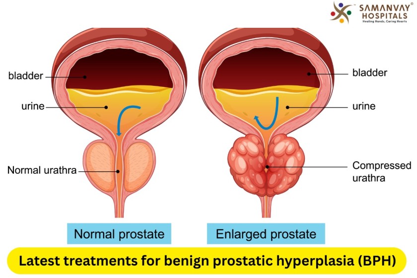 Latest treatments for benign prostatic hyperplasia (BPH)