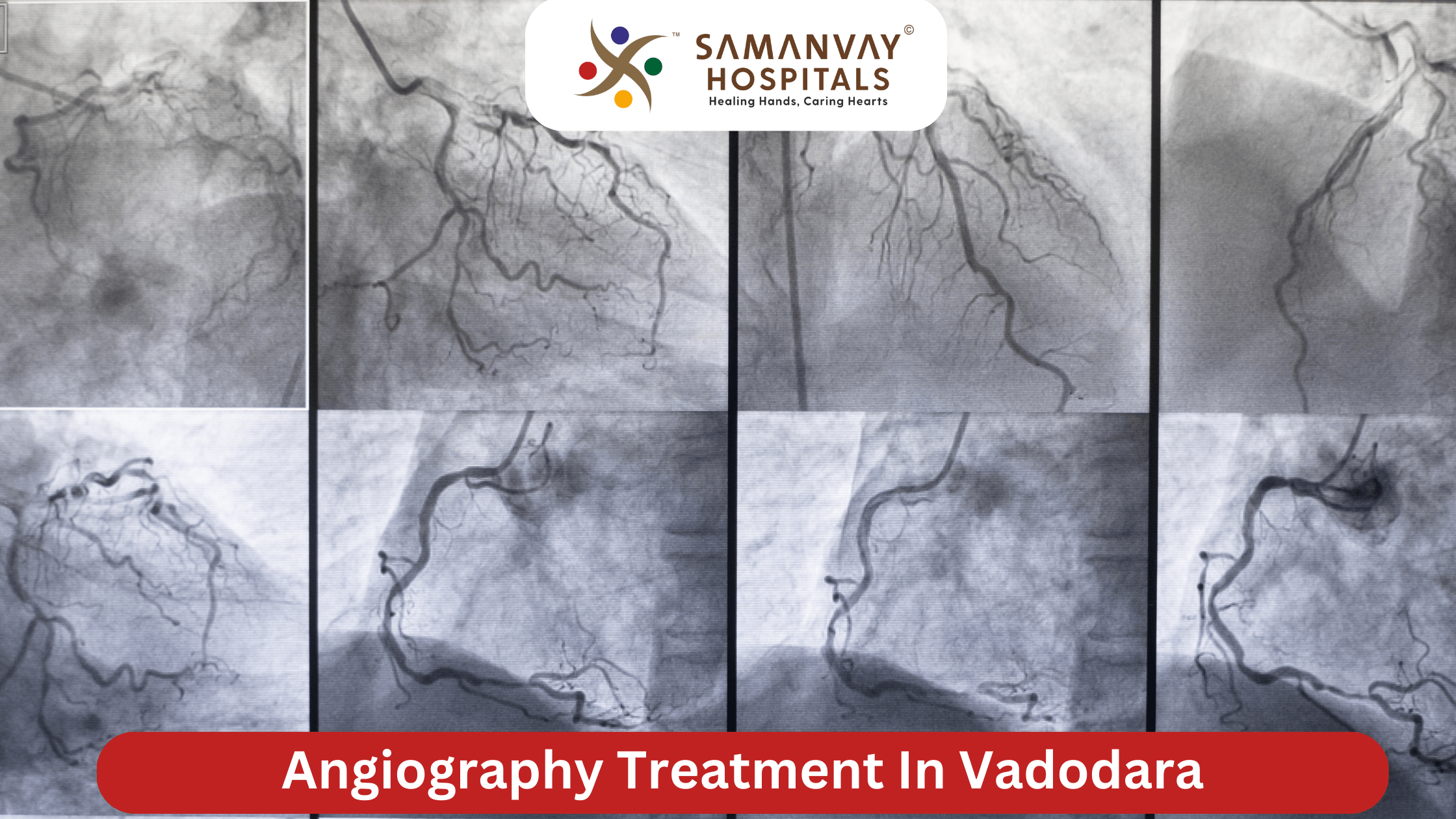 Angiography Treatment in Vadodara