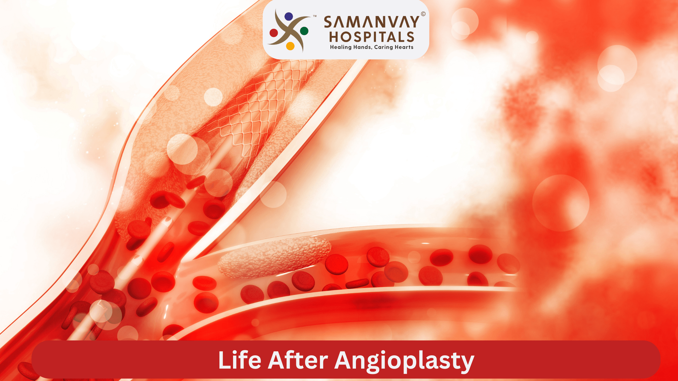 Life After Angioplasty: A 30-Day Recovery Roadmap